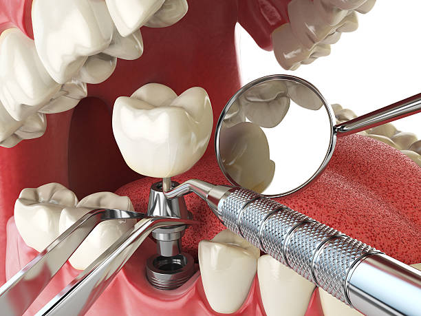 Best Emergency Root Canal Treatment in Belmont, CA